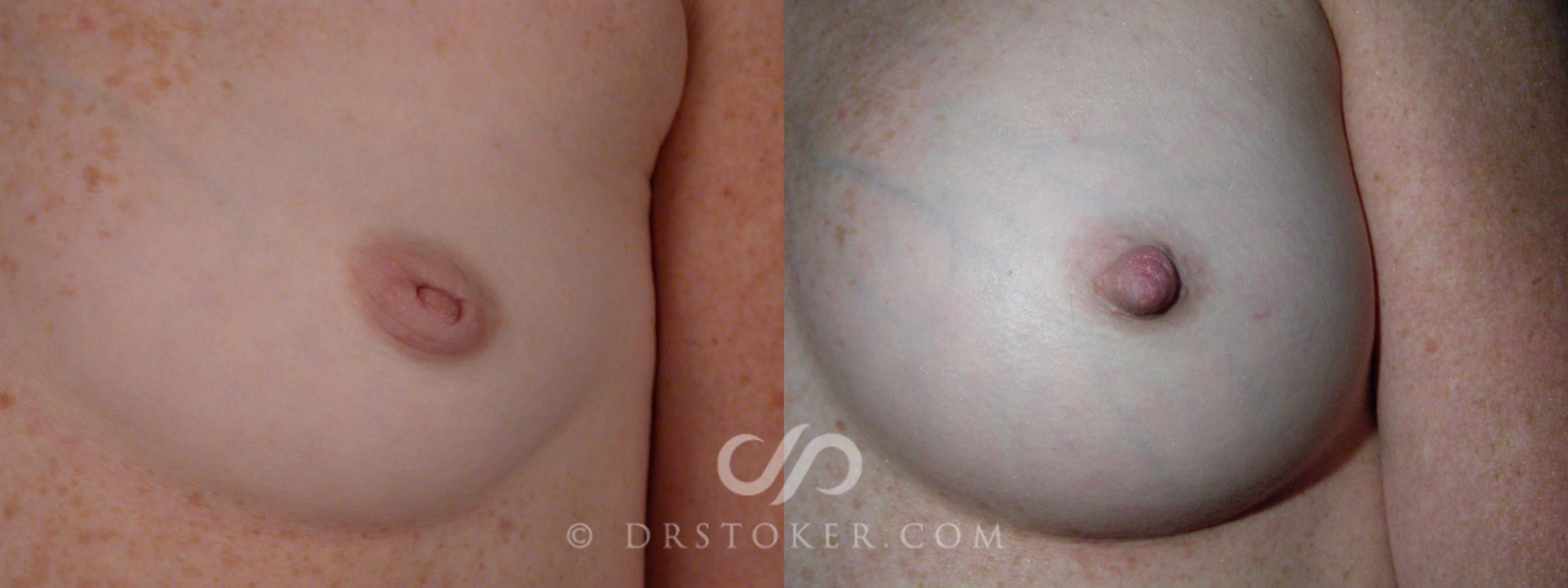 Before & After Nipple - Inversion Correction Case 233 View #1 View in Los Angeles, CA