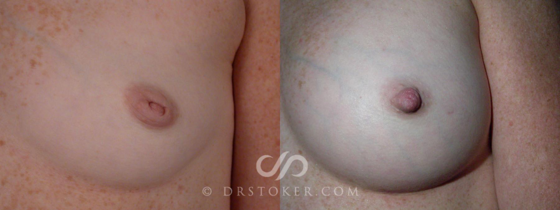 Before & After Nipple - Inversion Correction Case 233 View #1 View in Los Angeles, CA