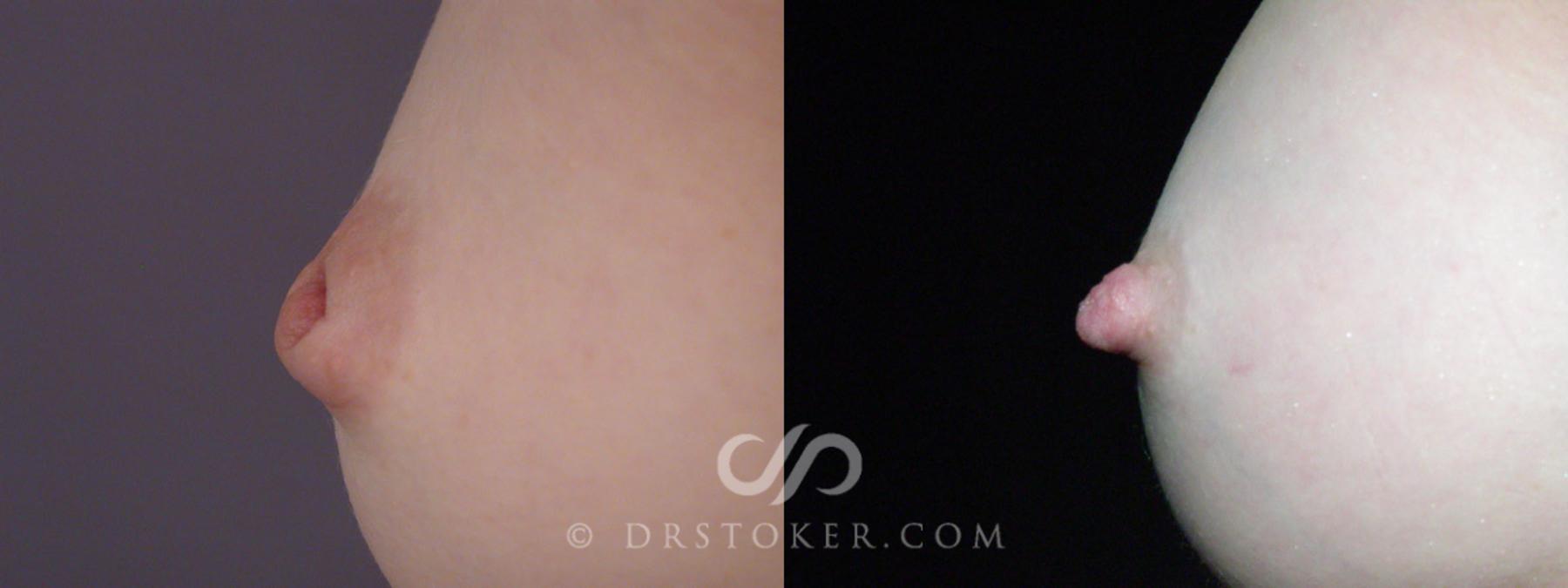 Before & After Nipple - Inversion Correction Case 233 View #2 View in Los Angeles, CA