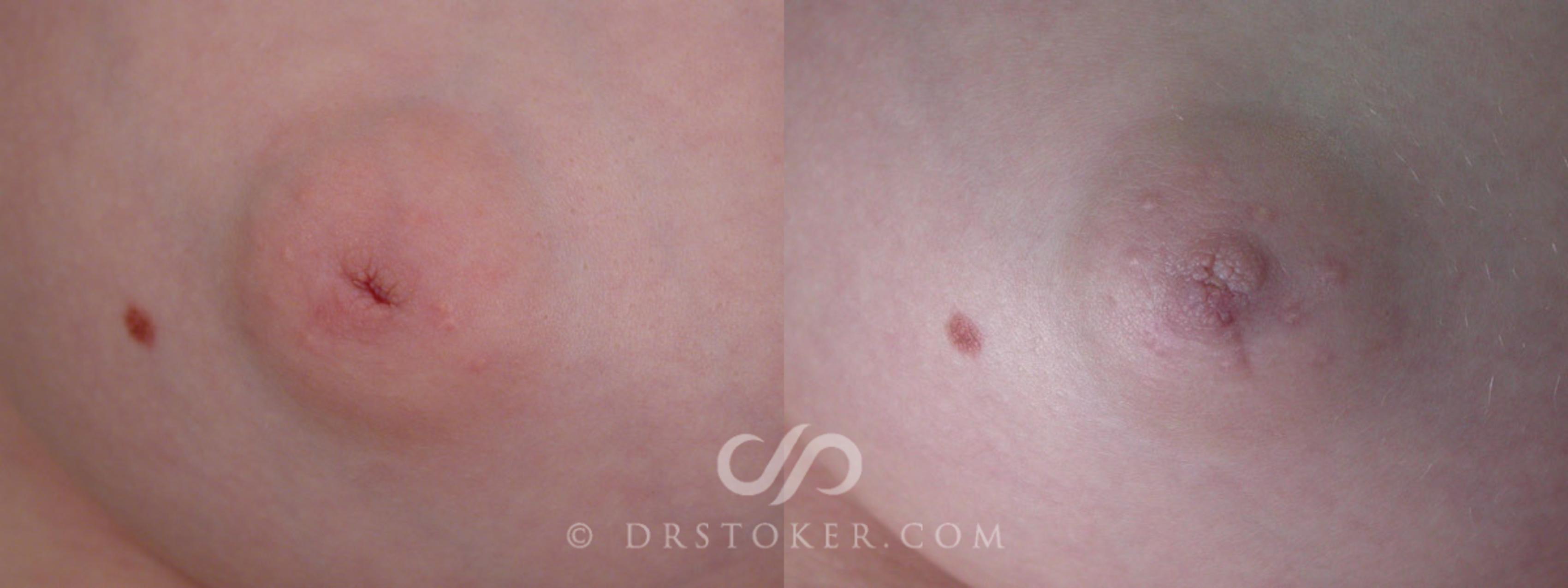 Before & After Nipple - Inversion Correction Case 234 View #1 View in Los Angeles, CA