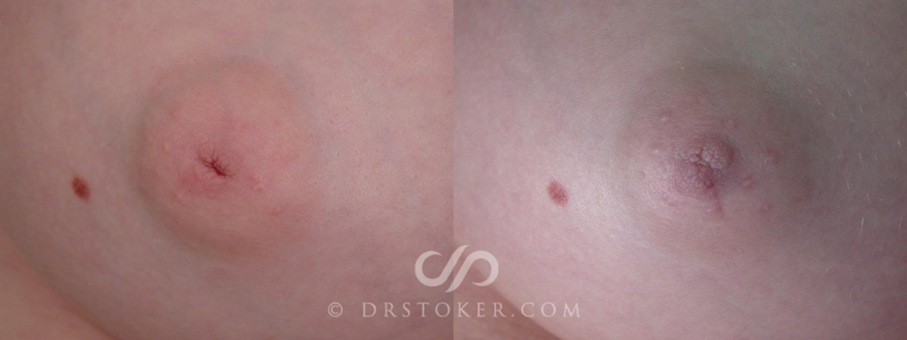 Before & After Nipple - Inversion Correction Case 234 View #1 View in Los Angeles, CA