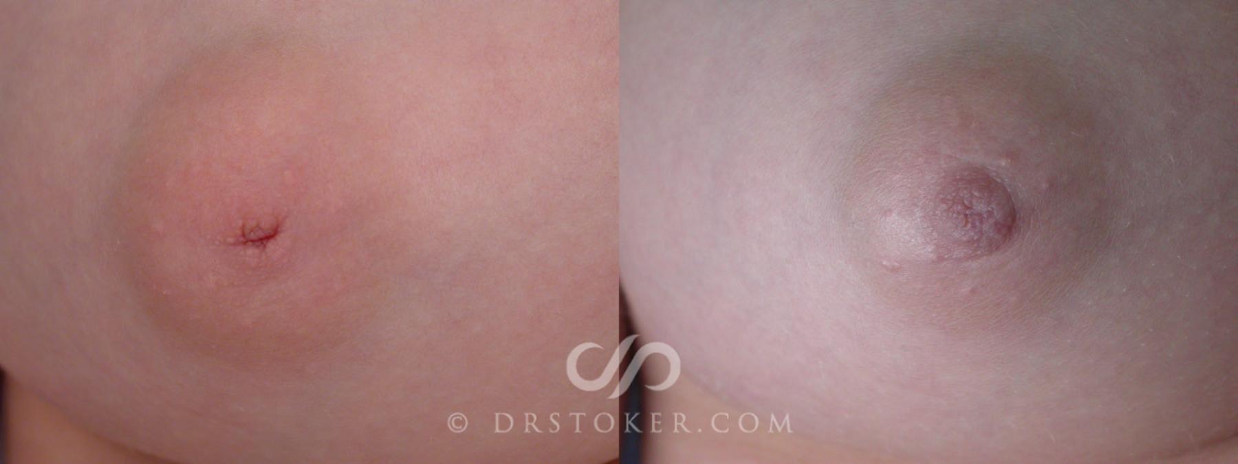 Before & After Nipple - Inversion Correction Case 234 View #2 View in Los Angeles, CA