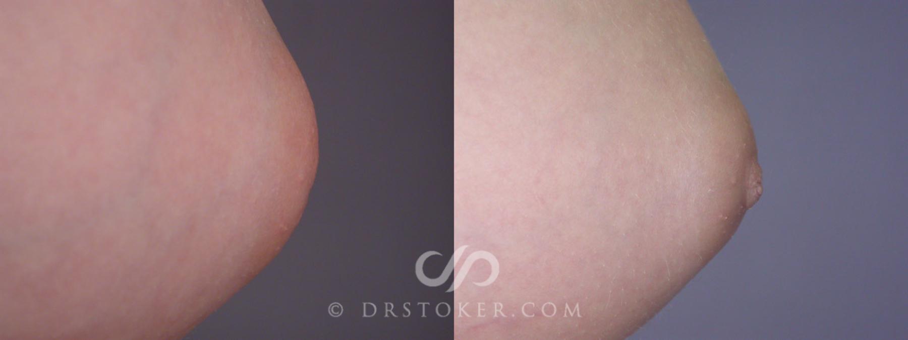Before & After Nipple - Inversion Correction Case 234 View #3 View in Los Angeles, CA