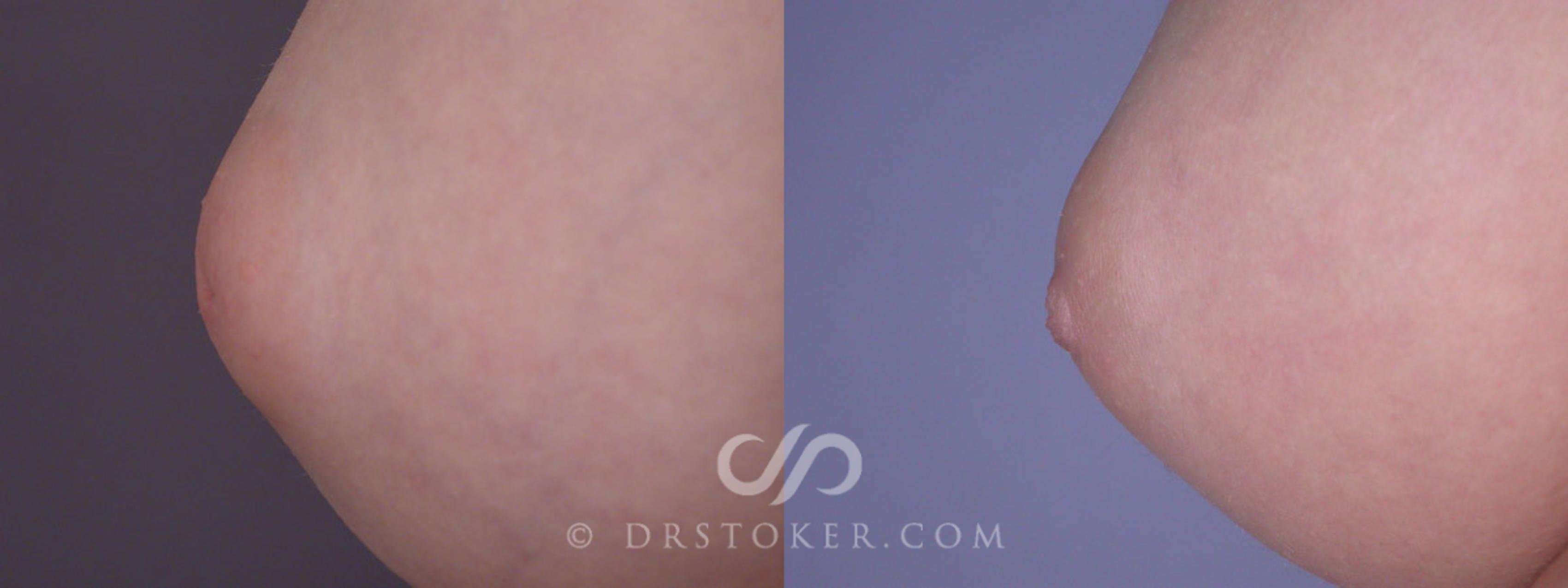 Before & After Nipple - Inversion Correction Case 234 View #4 View in Los Angeles, CA