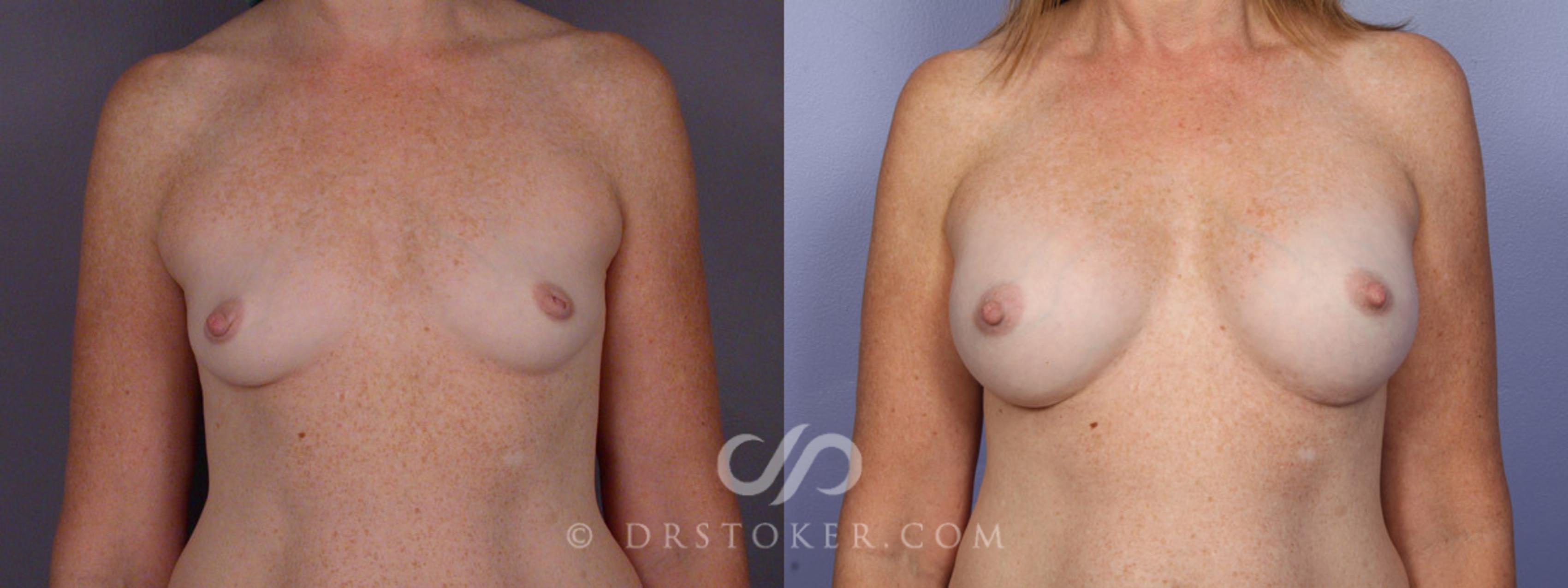 Before & After Nipple - Inversion Correction Case 331 View #1 View in Los Angeles, CA
