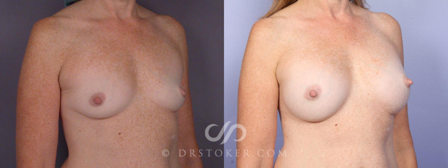 Before & After Breast Augmentation, Rapid Recovery Case 331 View #2 View in Los Angeles, CA