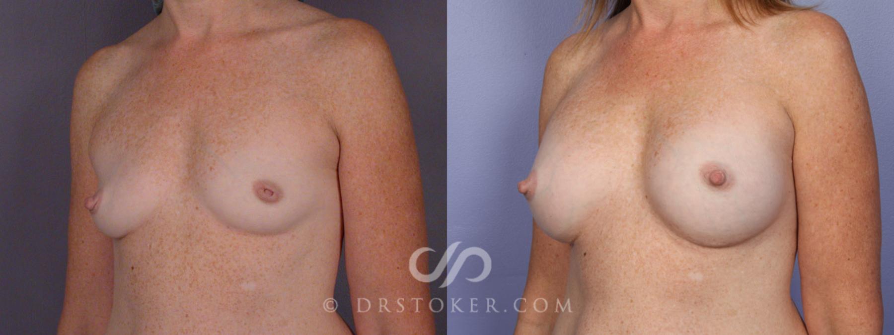 Before & After Nipple - Inversion Correction Case 331 View #3 View in Los Angeles, CA