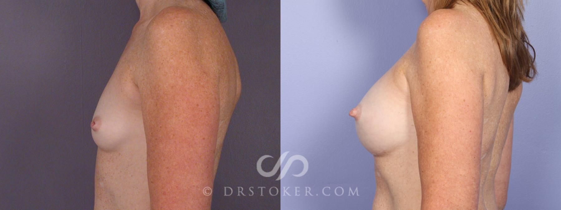 Before & After Nipple - Inversion Correction Case 331 View #4 View in Los Angeles, CA