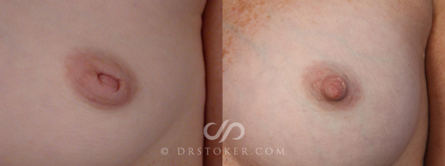 Before & After Nipple - Inversion Correction Case 331 View #5 View in Los Angeles, CA
