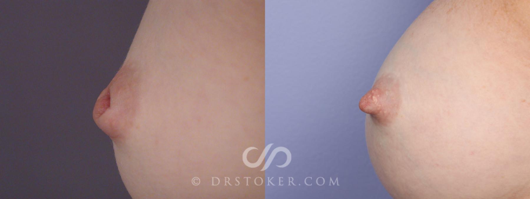Before & After Nipple - Inversion Correction Case 331 View #6 View in Los Angeles, CA