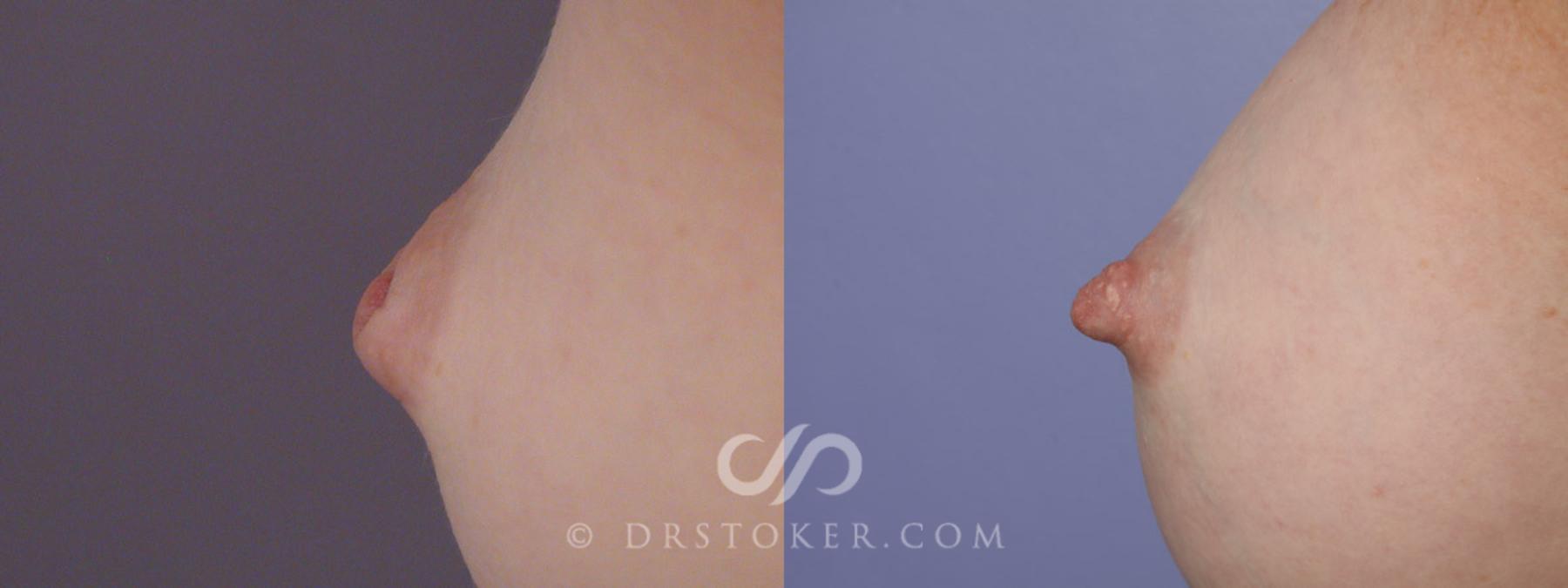 Before & After Nipple - Inversion Correction Case 331 View #7 View in Los Angeles, CA