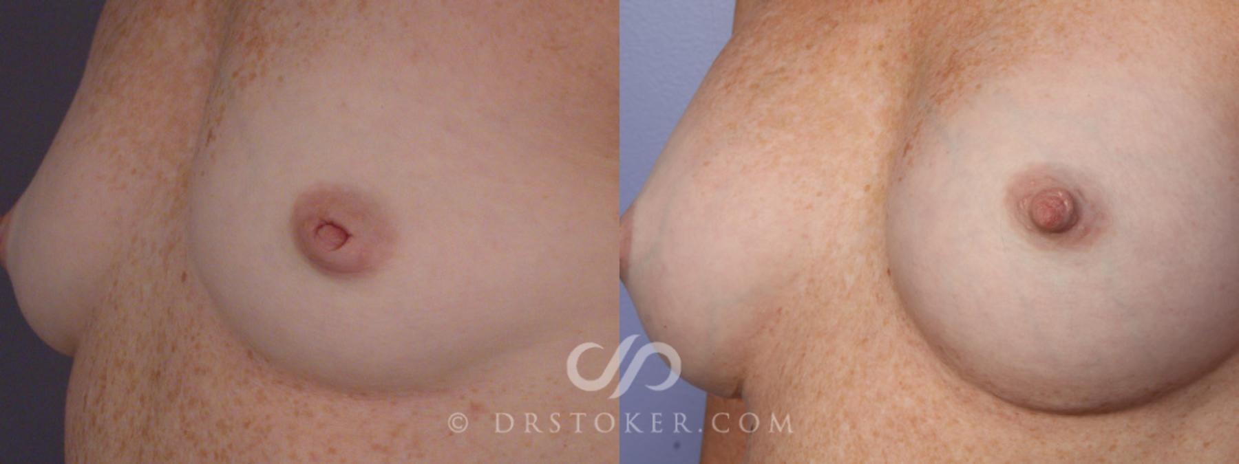 Before & After Breast Augmentation, Rapid Recovery Case 331 View #8 View in Los Angeles, CA