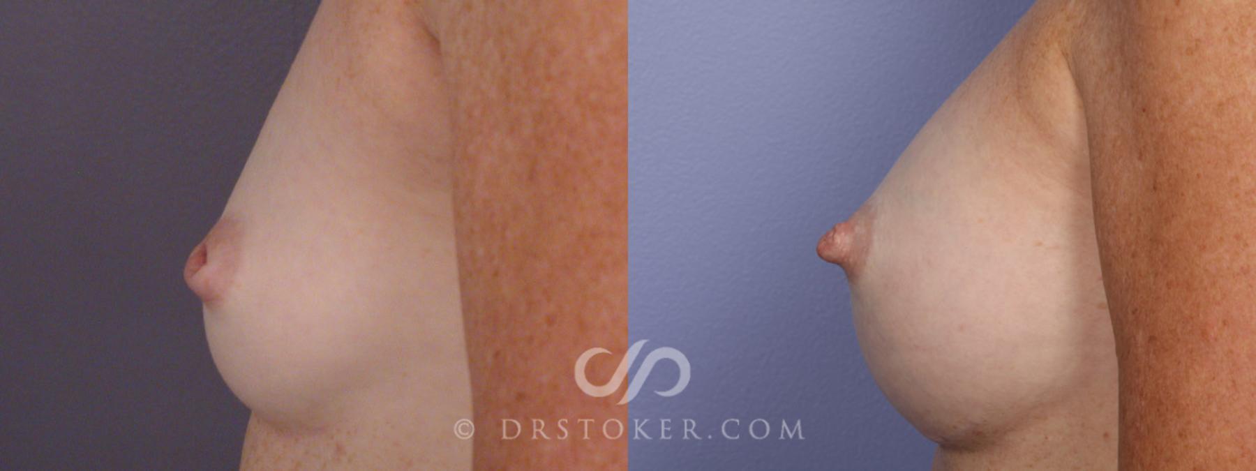 Before & After Nipple - Inversion Correction Case 331 View #9 View in Los Angeles, CA