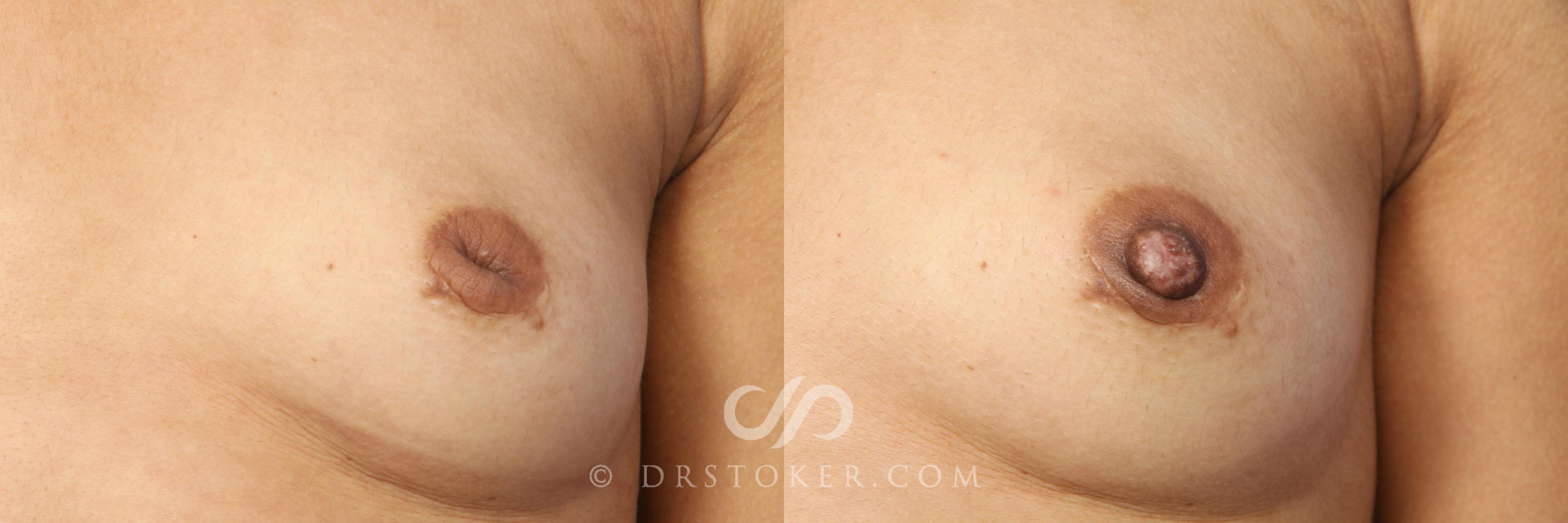 Before & After Nipple - Inversion Correction Case 380 View #2 View in Los Angeles, CA