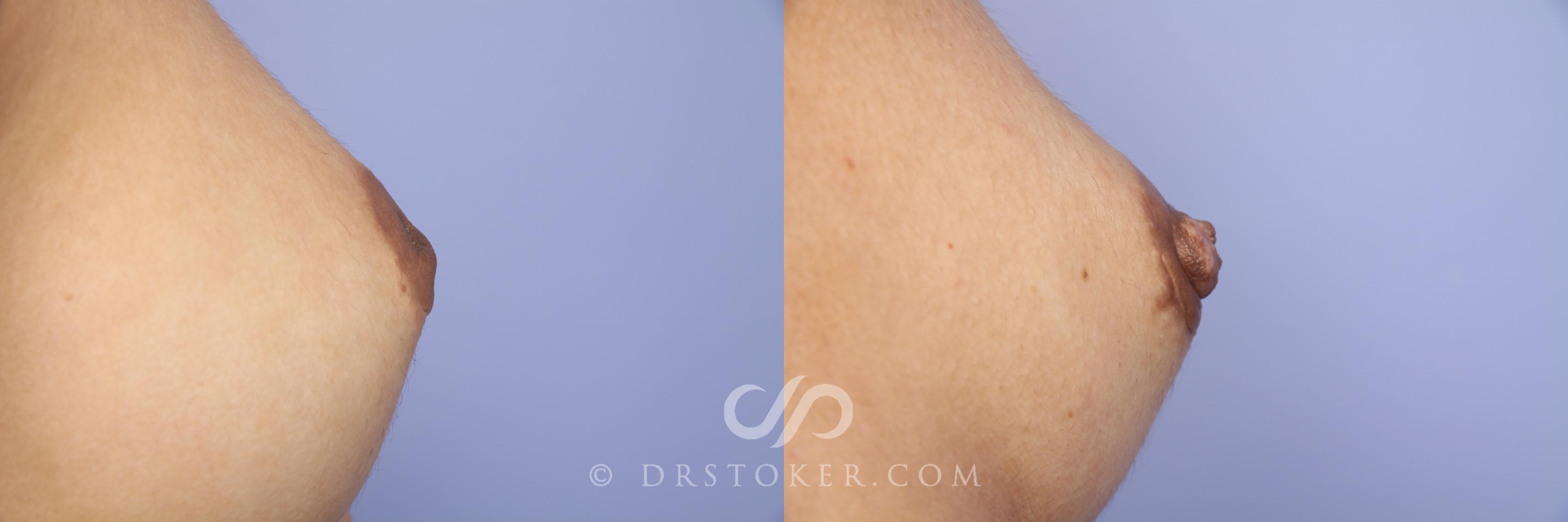 Before & After Nipple - Inversion Correction Case 380 View #3 View in Los Angeles, CA