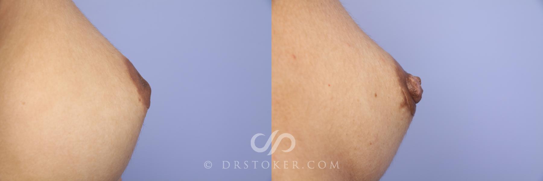 Before & After Nipple - Inversion Correction Case 380 View #3 View in Los Angeles, CA