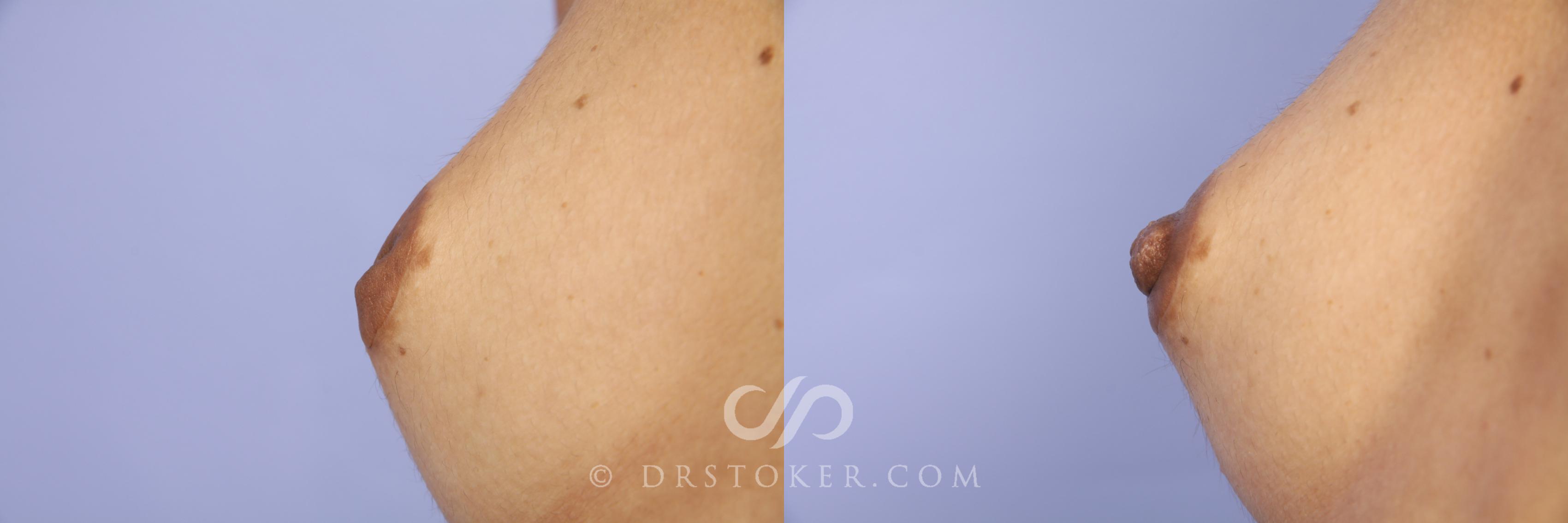 Before & After Nipple - Inversion Correction Case 380 View #4 View in Los Angeles, CA