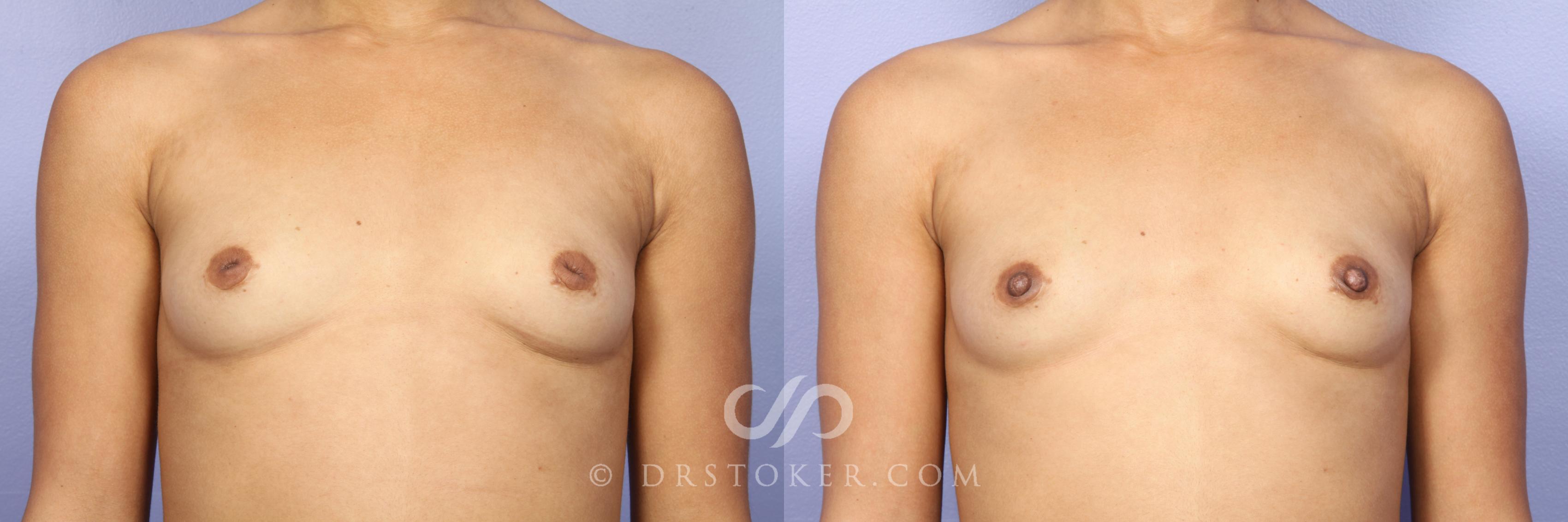 Before & After Nipple - Inversion Correction Case 380 View #5 View in Los Angeles, CA