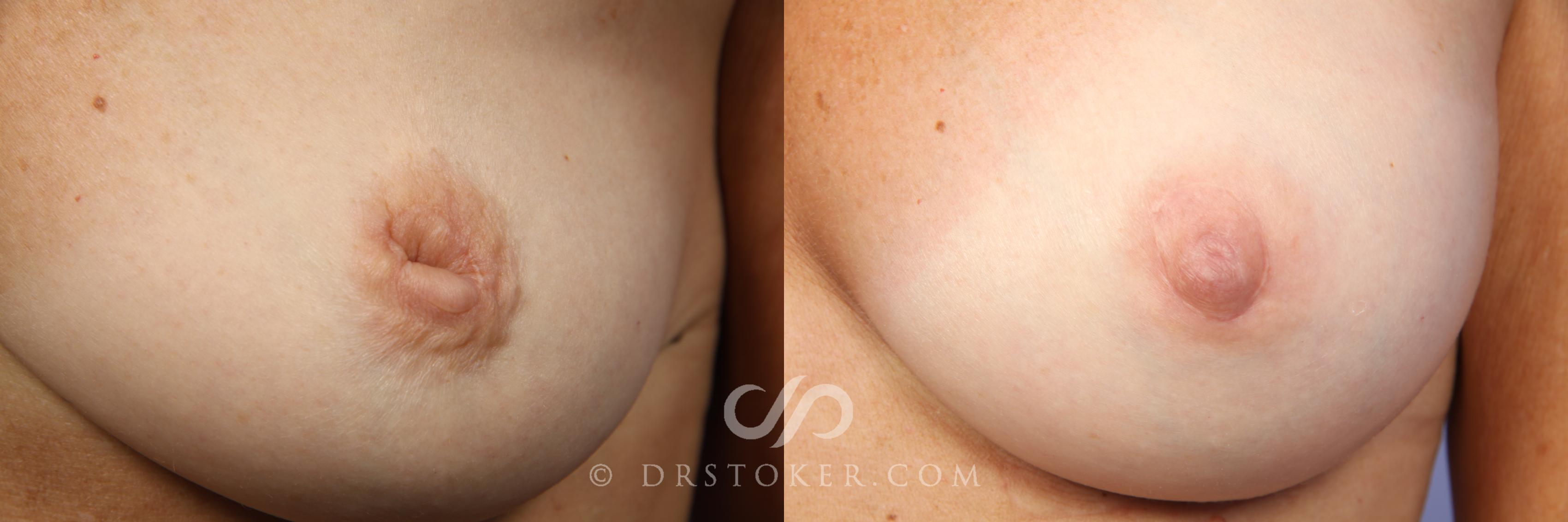 Before & After Nipple - Inversion Correction Case 456 View #2 View in Los Angeles, CA