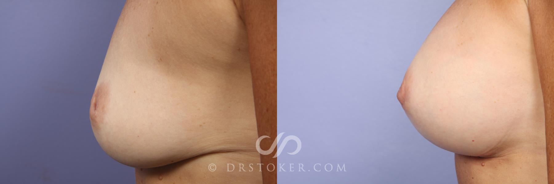 Before & After Nipple - Inversion Correction Case 456 View #3 View in Los Angeles, CA