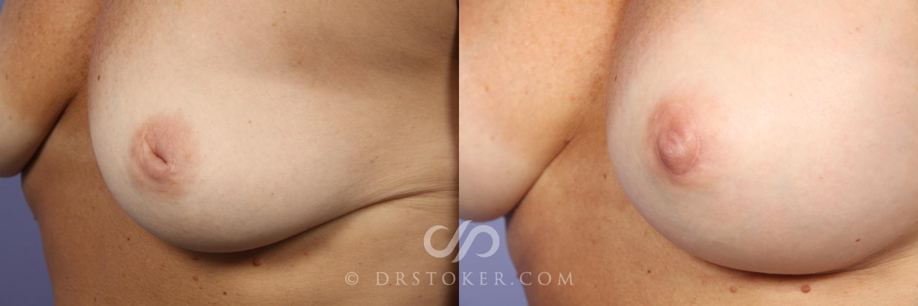 Before & After Nipple - Inversion Correction Case 456 View #4 View in Los Angeles, CA