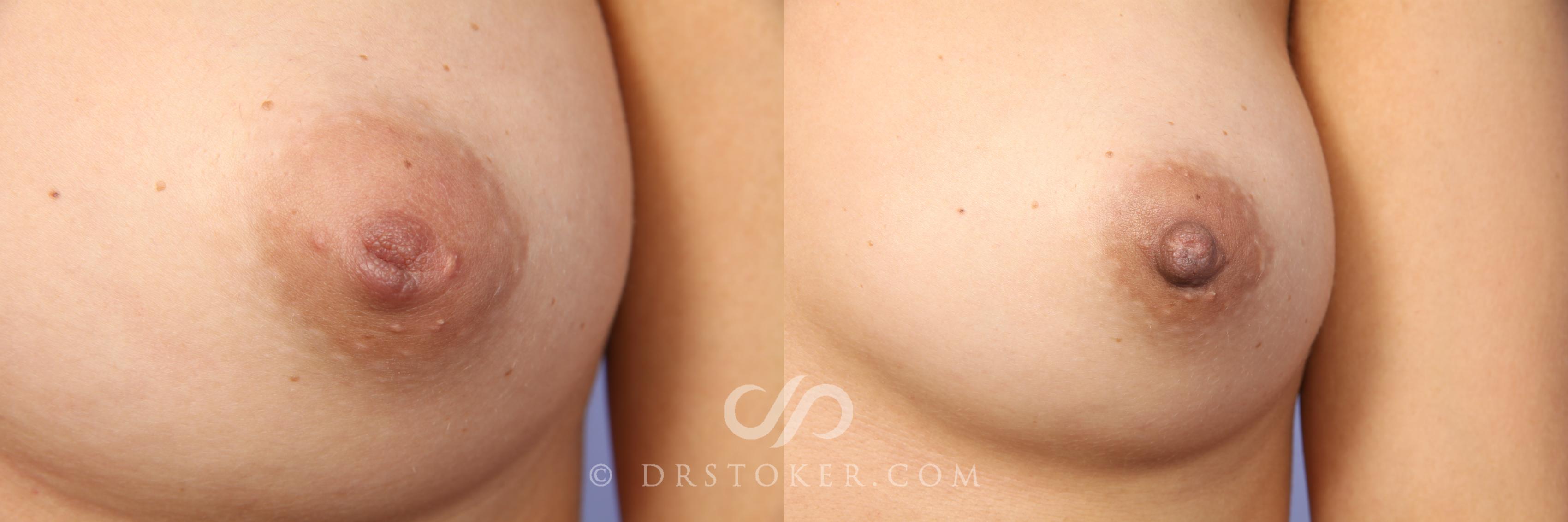 Before & After Nipple - Inversion Correction Case 457 View #1 View in Los Angeles, CA