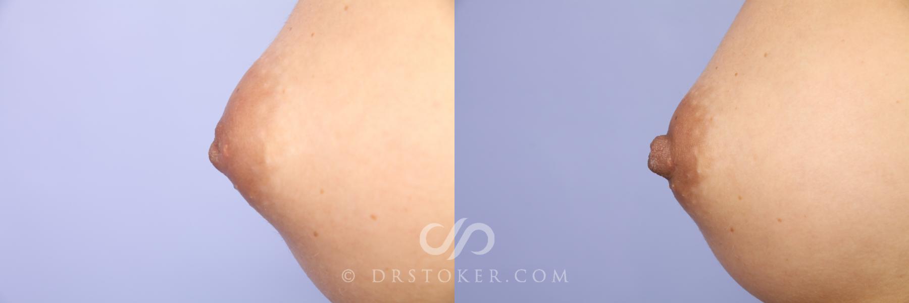 Before & After Nipple - Inversion Correction Case 457 View #2 View in Los Angeles, CA