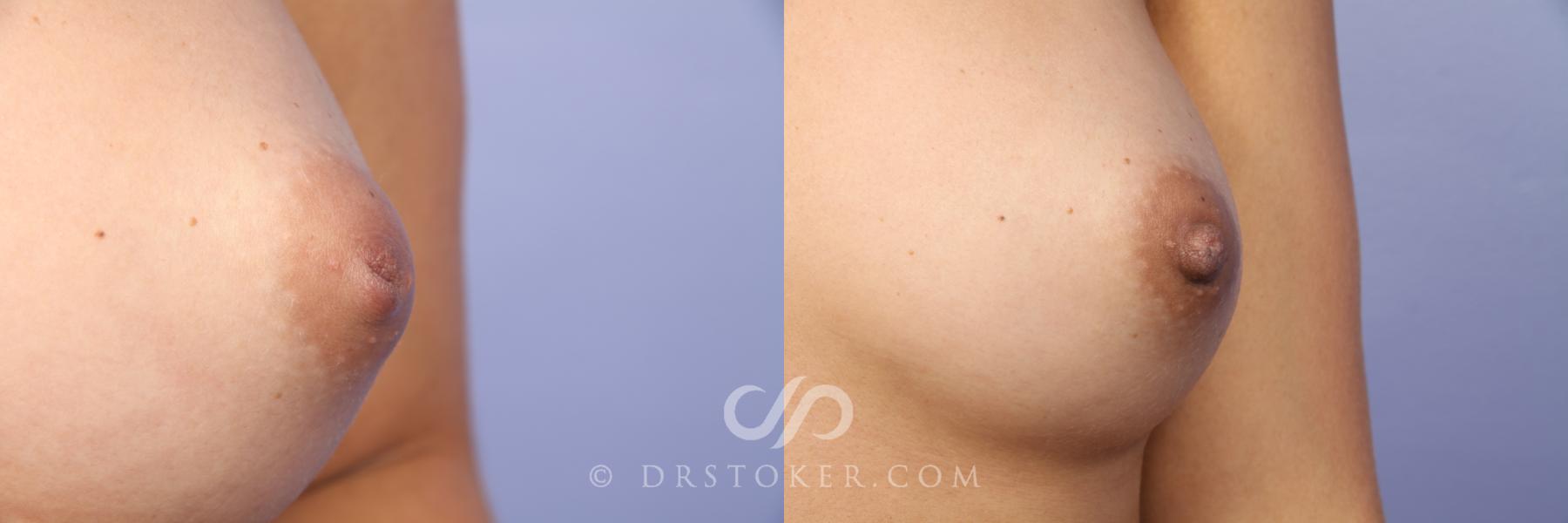 Before & After Nipple - Inversion Correction Case 457 View #3 View in Los Angeles, CA