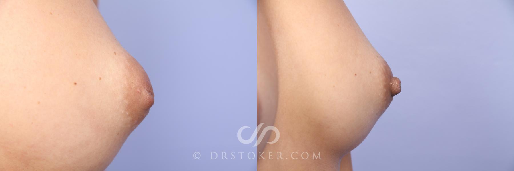 Before & After Nipple - Inversion Correction Case 457 View #4 View in Los Angeles, CA