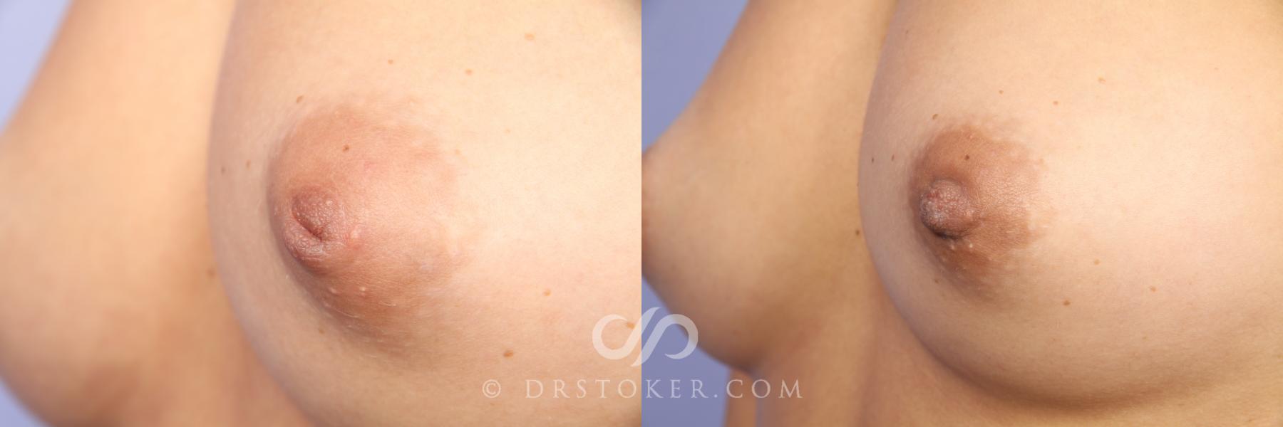 Before & After Nipple - Inversion Correction Case 457 View #5 View in Los Angeles, CA