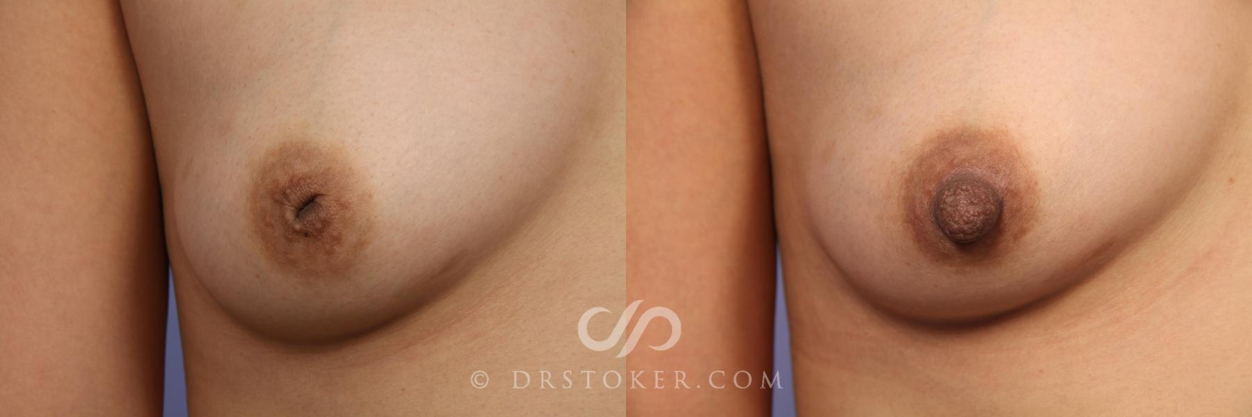 Before & After Nipple - Inversion Correction Case 492 View #1 View in Los Angeles, CA