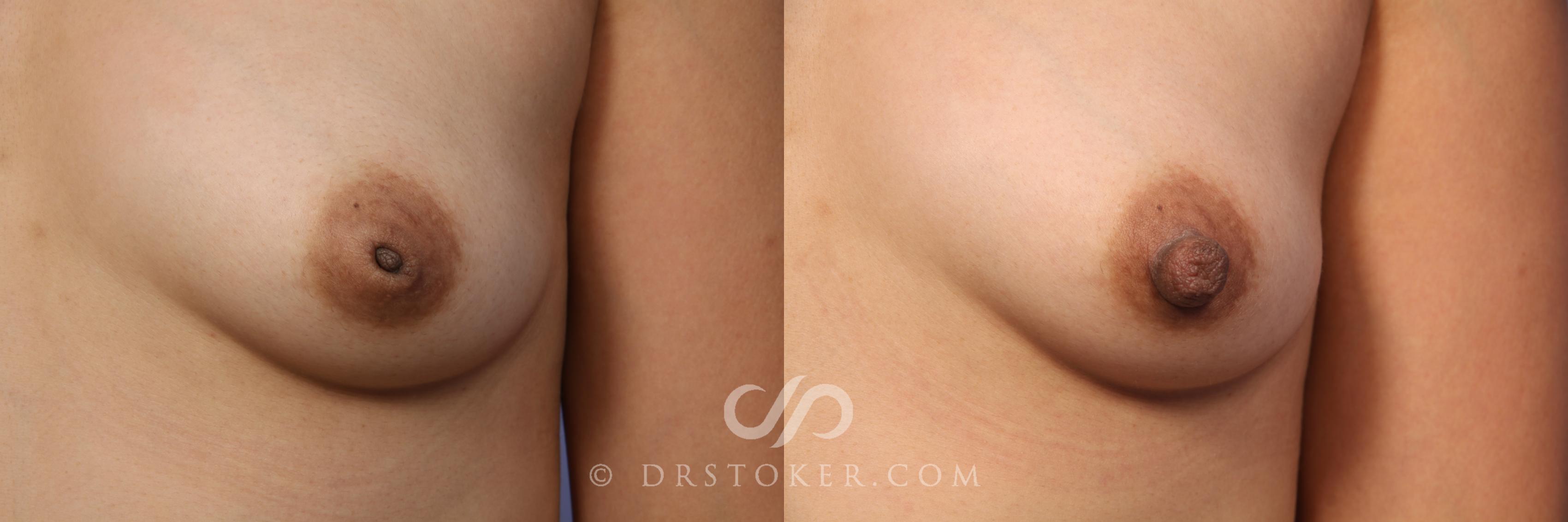 Nipple Inversion Correction Before And After Pictures Case Los