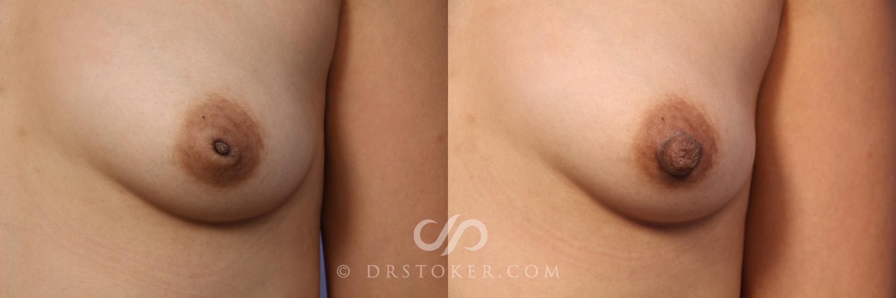 Before & After Nipple - Inversion Correction Case 492 View #2 View in Los Angeles, CA