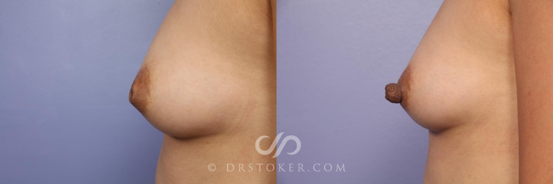Before & After Nipple - Inversion Correction Case 492 View #3 View in Los Angeles, CA