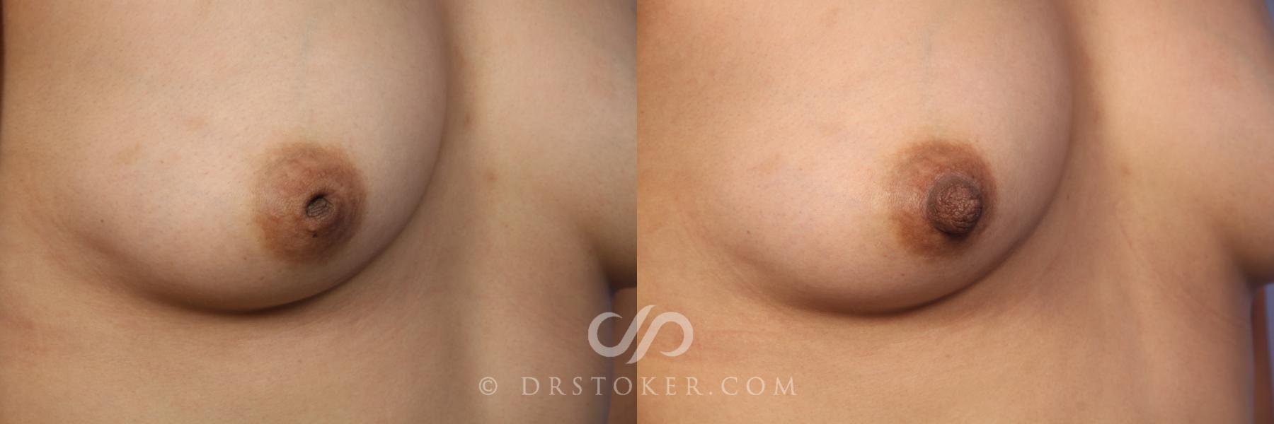 Before & After Nipple - Inversion Correction Case 492 View #4 View in Los Angeles, CA