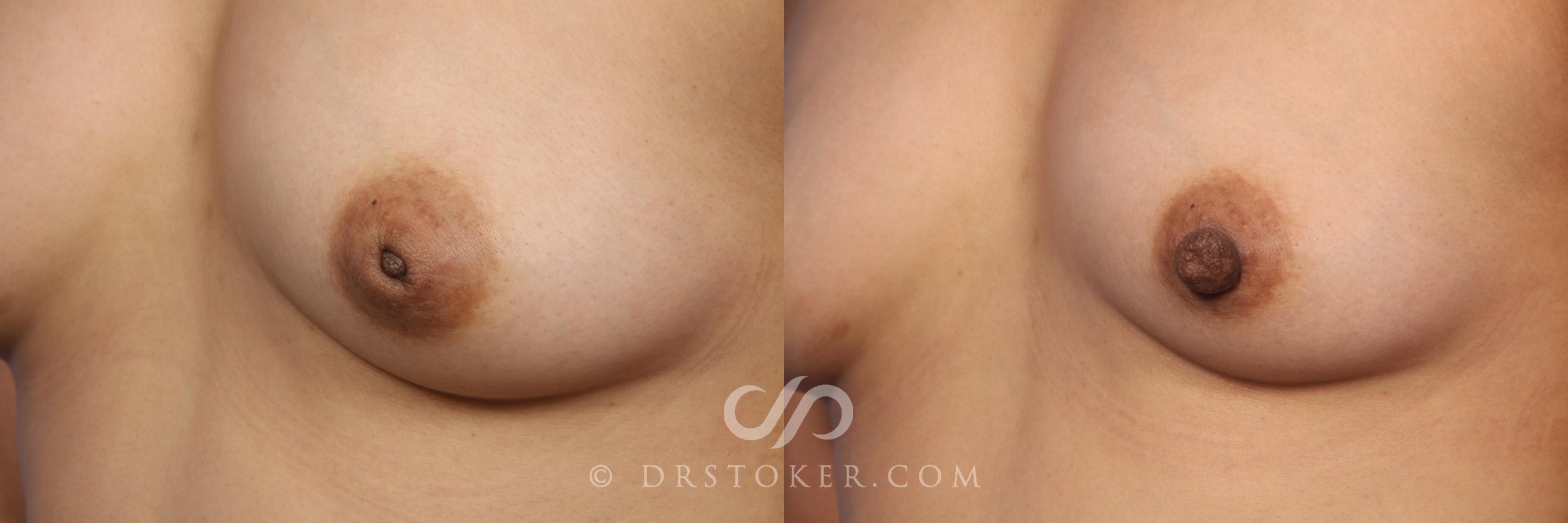 Before & After Nipple - Inversion Correction Case 492 View #5 View in Los Angeles, CA