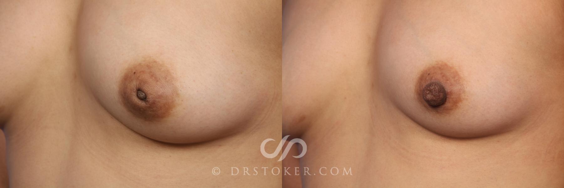 Before & After Nipple - Inversion Correction Case 492 View #5 View in Los Angeles, CA