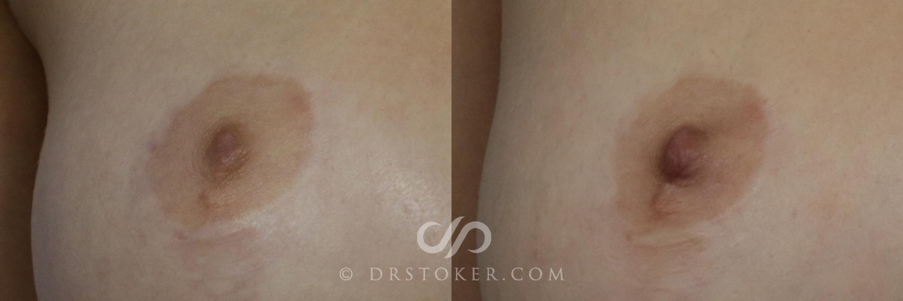 Before & After Nipple - Inversion Correction Case 746 View #1 View in Los Angeles, CA