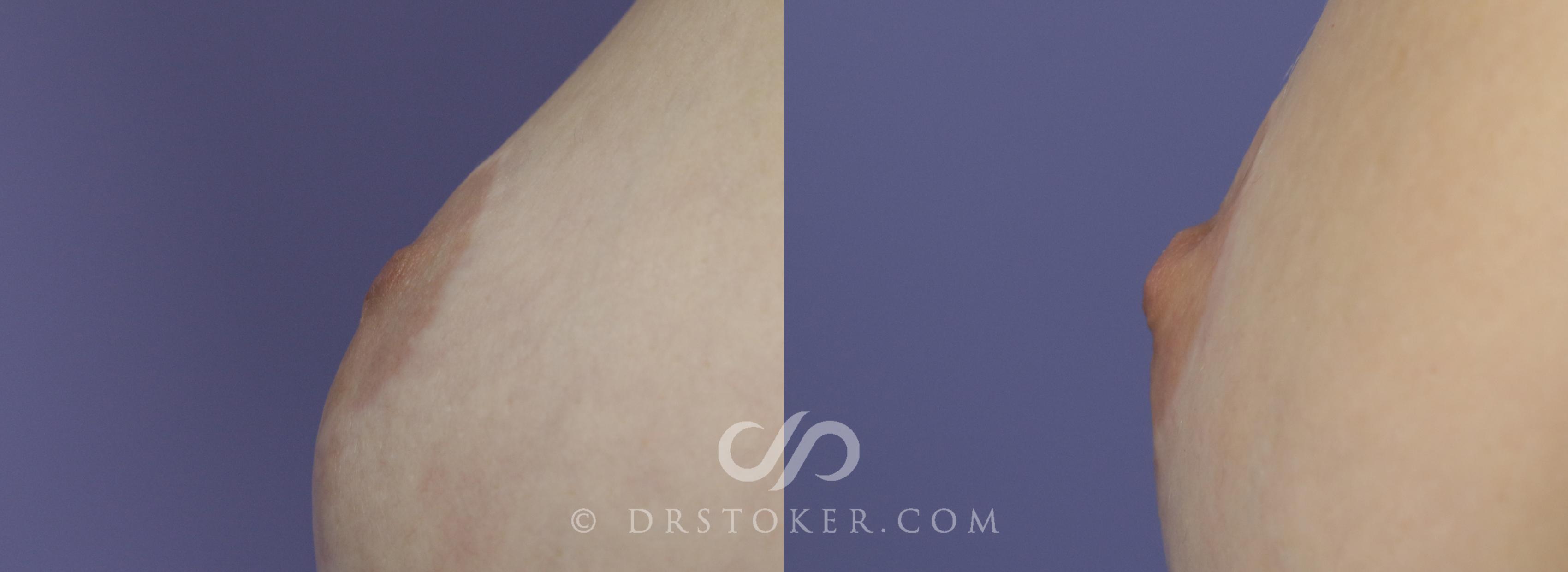 Before & After Nipple - Inversion Correction Case 748 View #1 View in Marina del Rey, CA