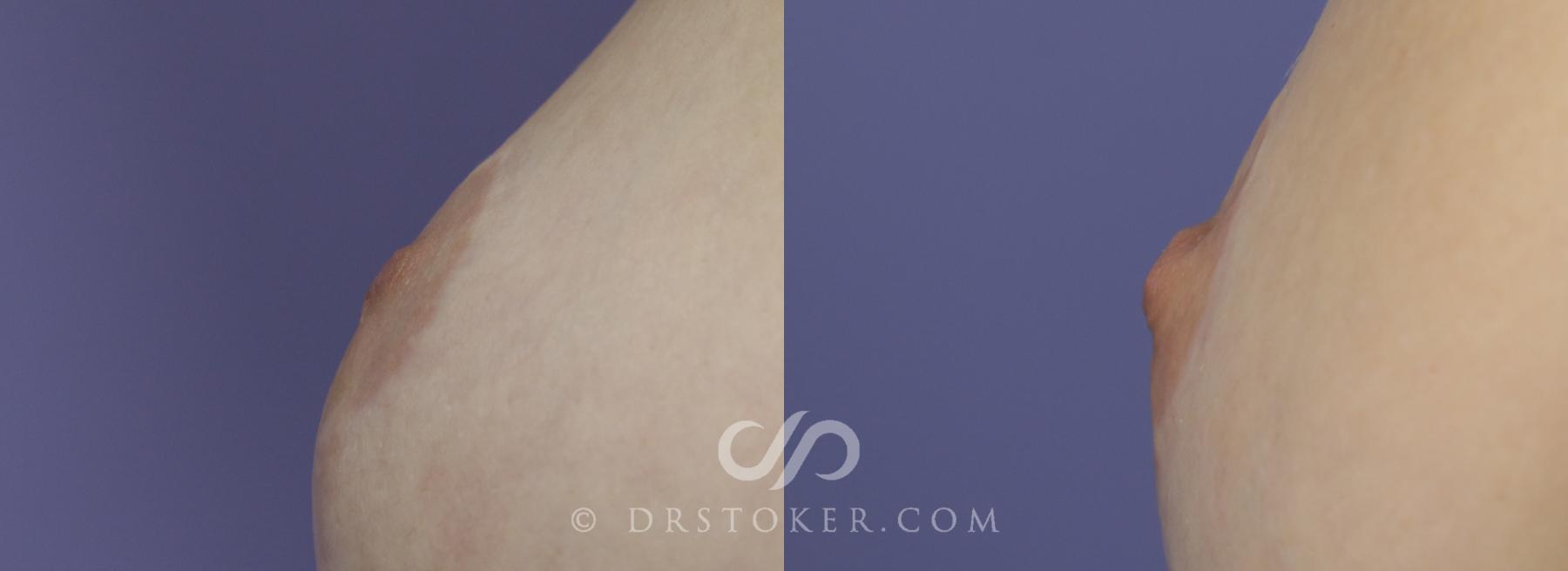 Before & After Nipple - Inversion Correction Case 748 View #1 View in Los Angeles, CA