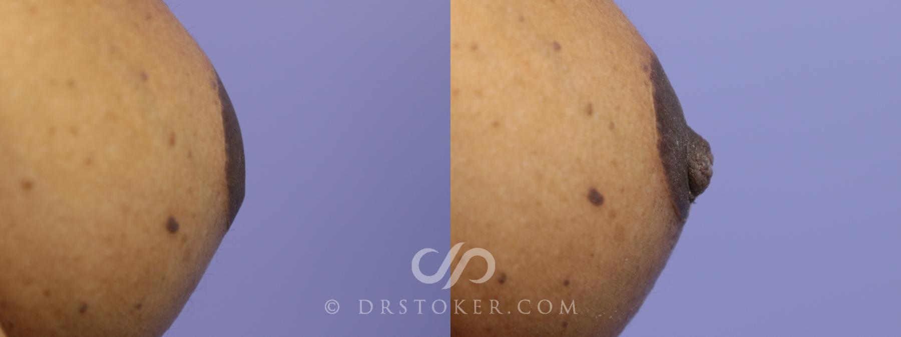 Before & After Nipple - Inversion Correction Case 749 View #1 View in Los Angeles, CA