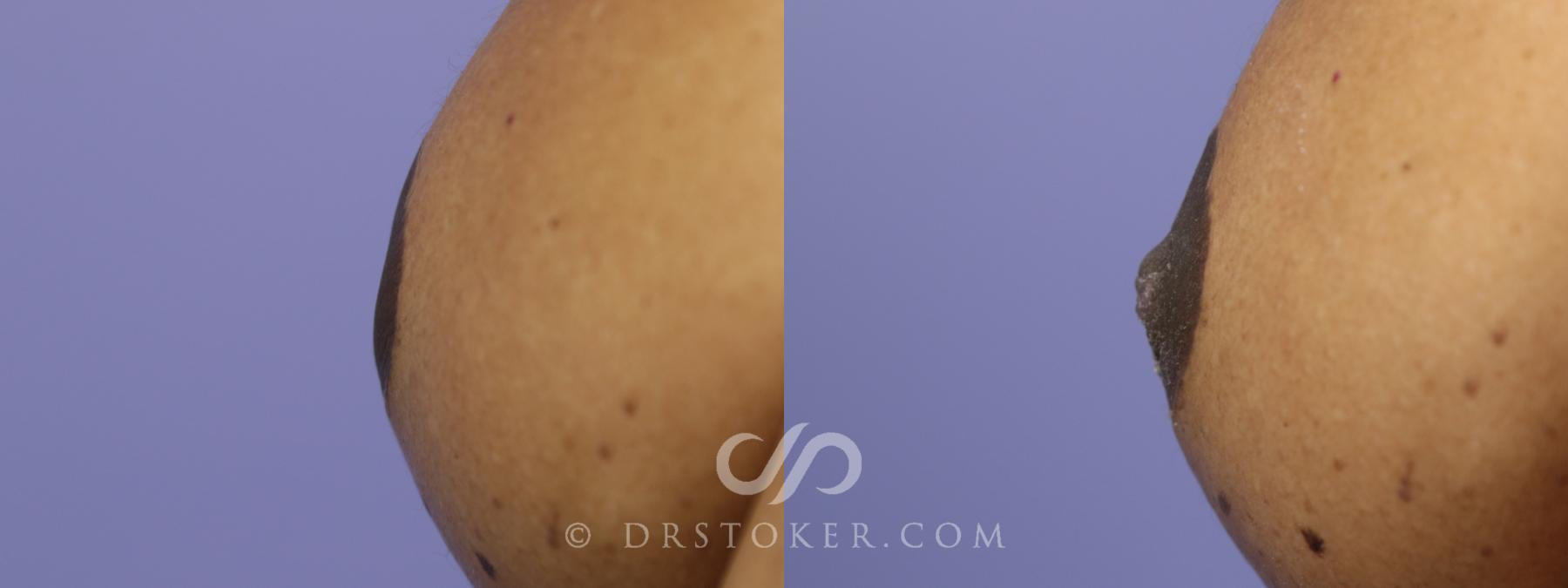 Before & After Nipple - Inversion Correction Case 755 View #1 View in Los Angeles, CA