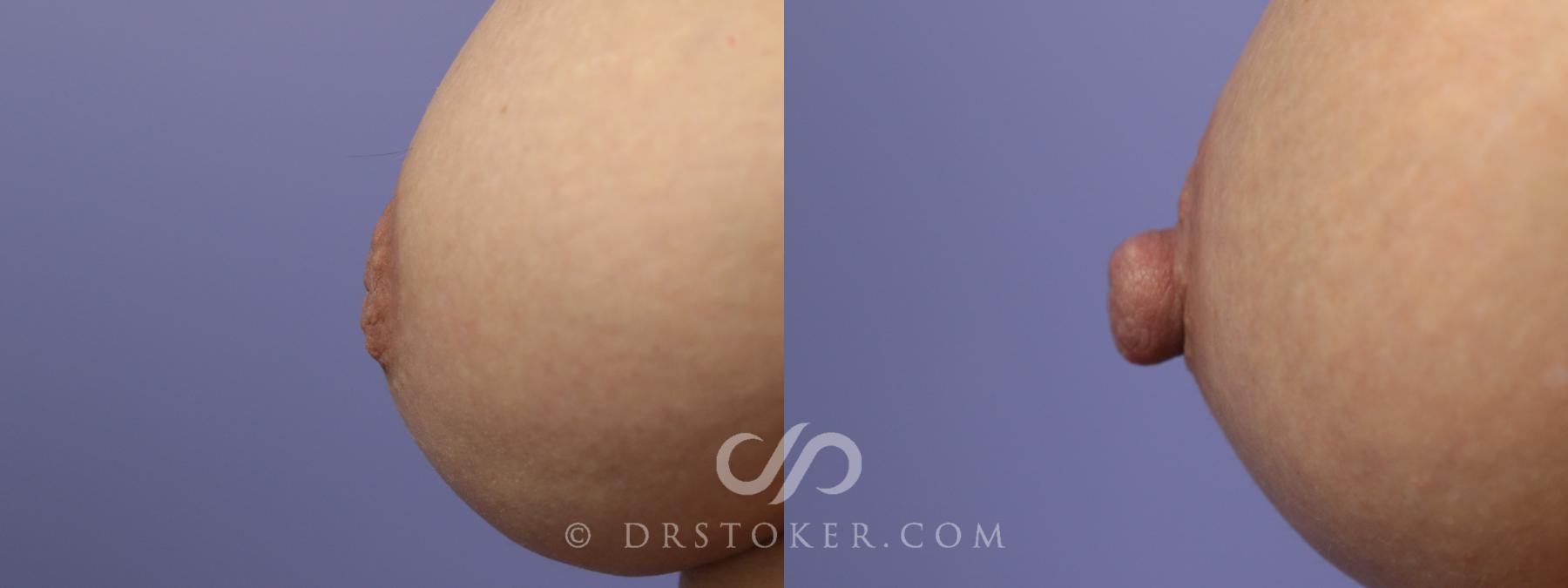 Before & After Nipple - Inversion Correction Case 757 View #1 View in Los Angeles, CA