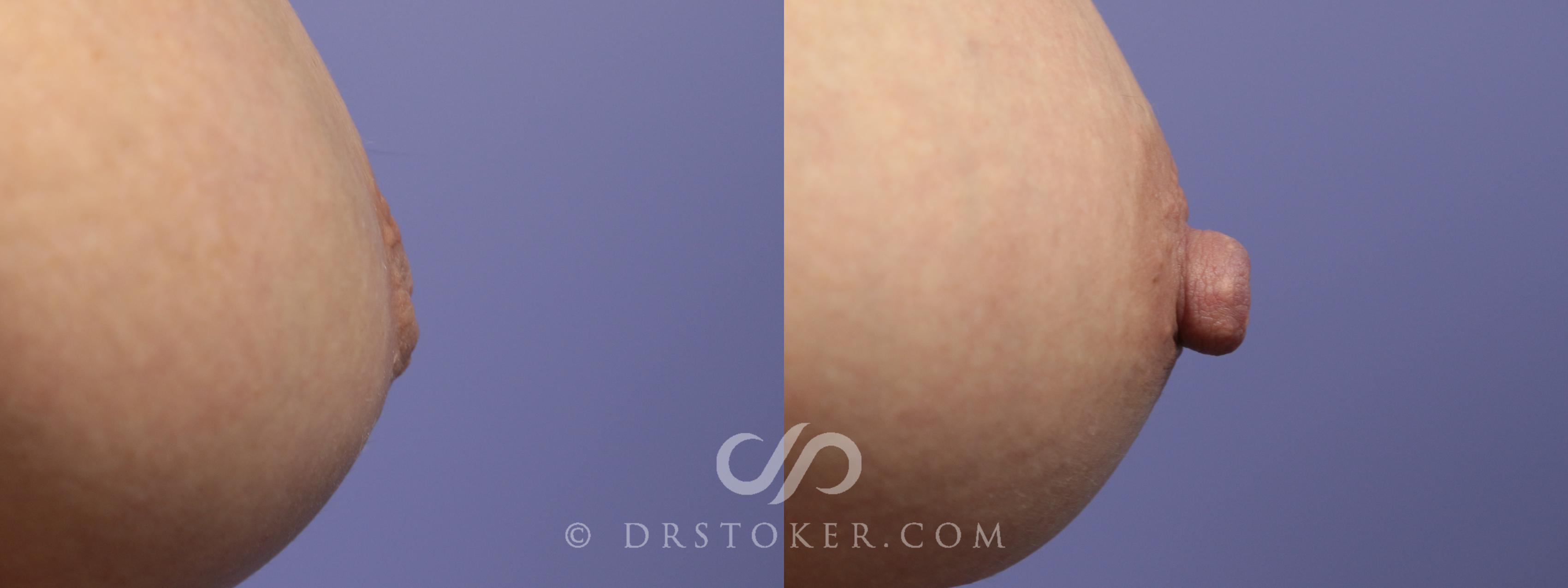 Before & After Nipple - Inversion Correction Case 758 View #1 View in Marina del Rey, CA
