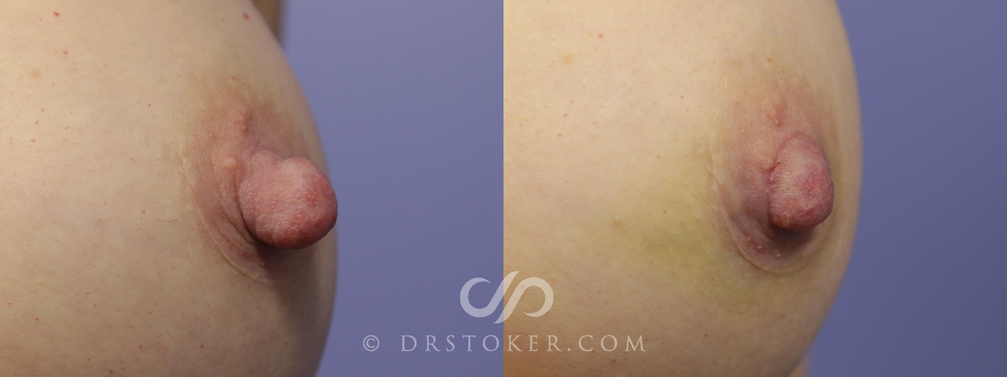 Before & After Nipple Reduction Case 1199 View #1 View in Marina del Rey, CA