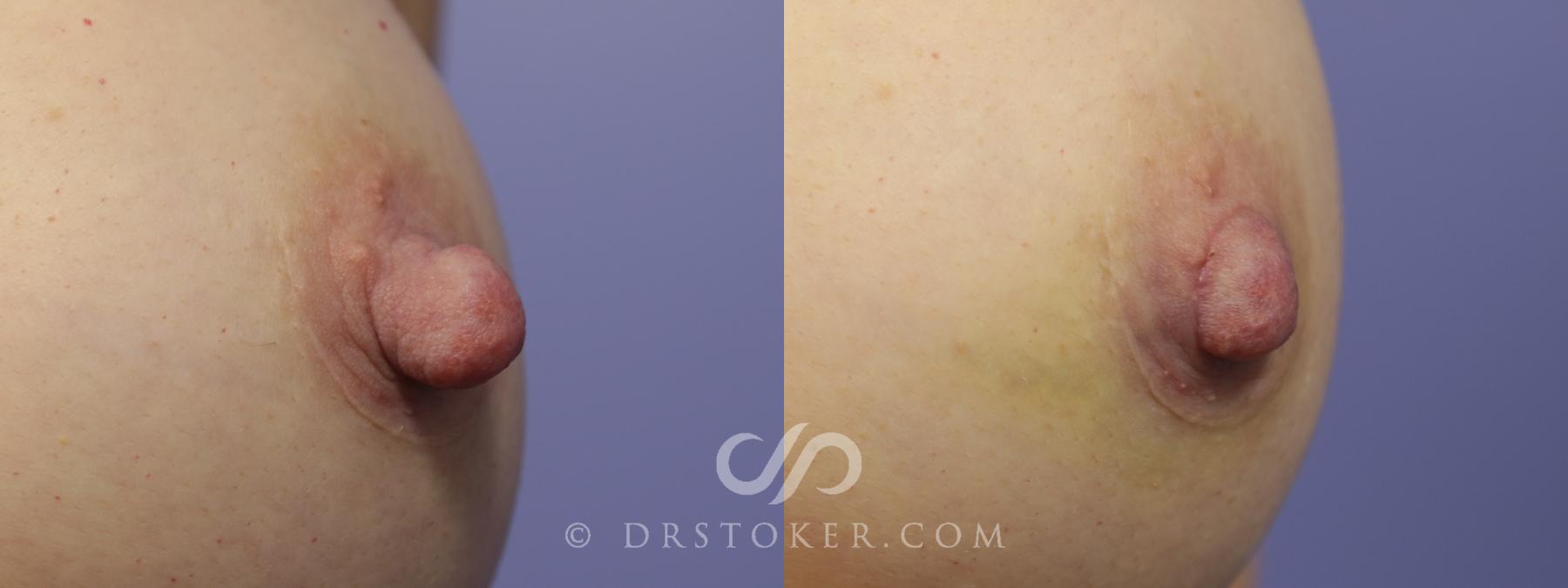 Before & After Nipple - Reduction Case 1199 View #1 View in Los Angeles, CA