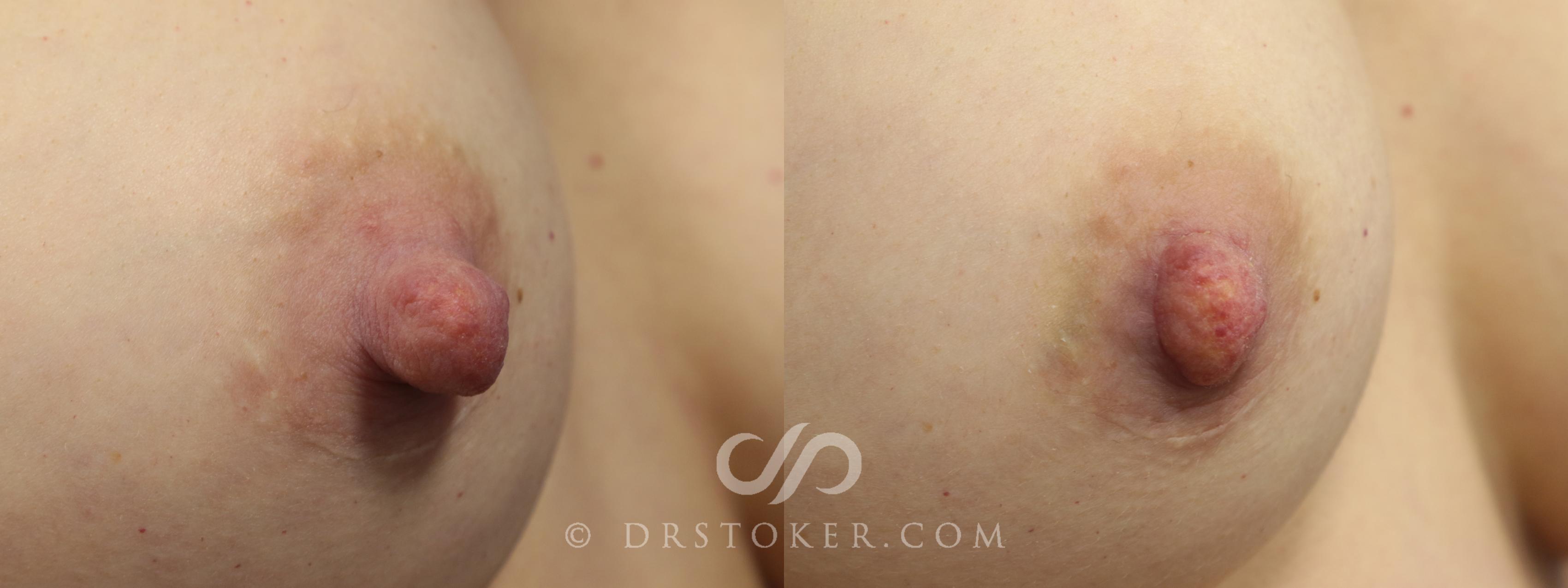 Before & After Nipple - Reduction Case 1200 View #1 View in Los Angeles, CA