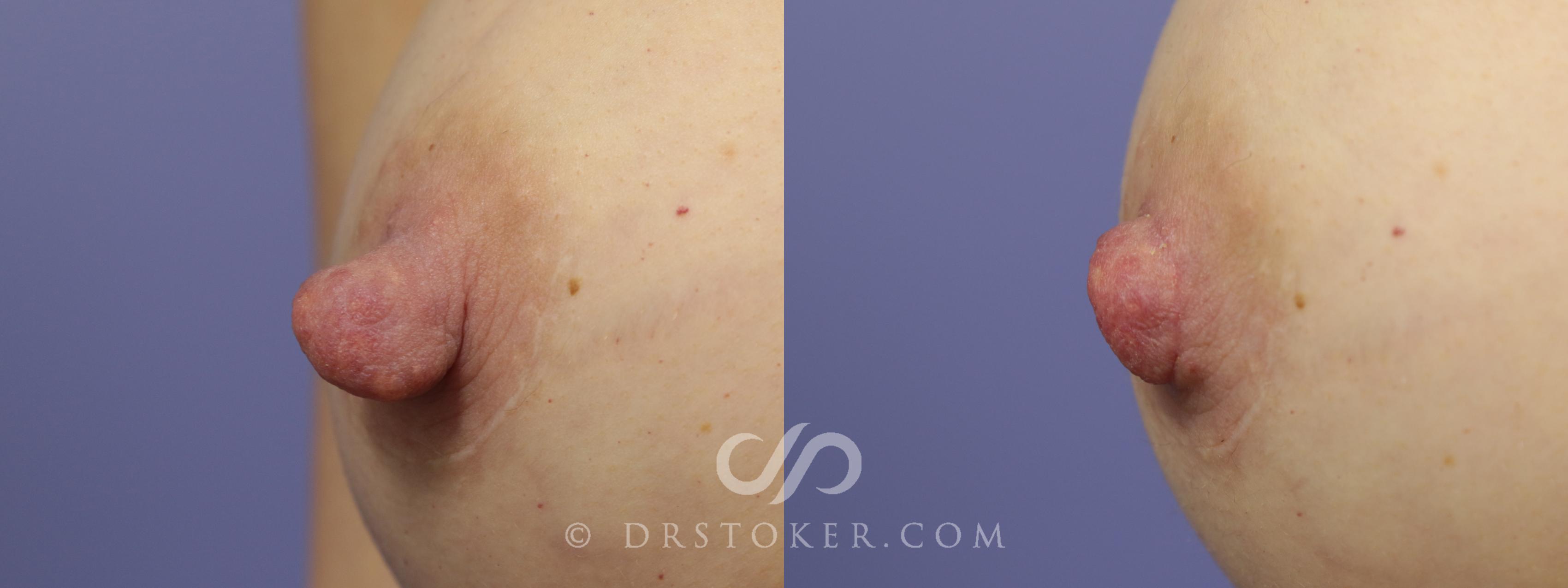 Before & After Nipple - Reduction Case 1202 View #1 View in Los Angeles, CA