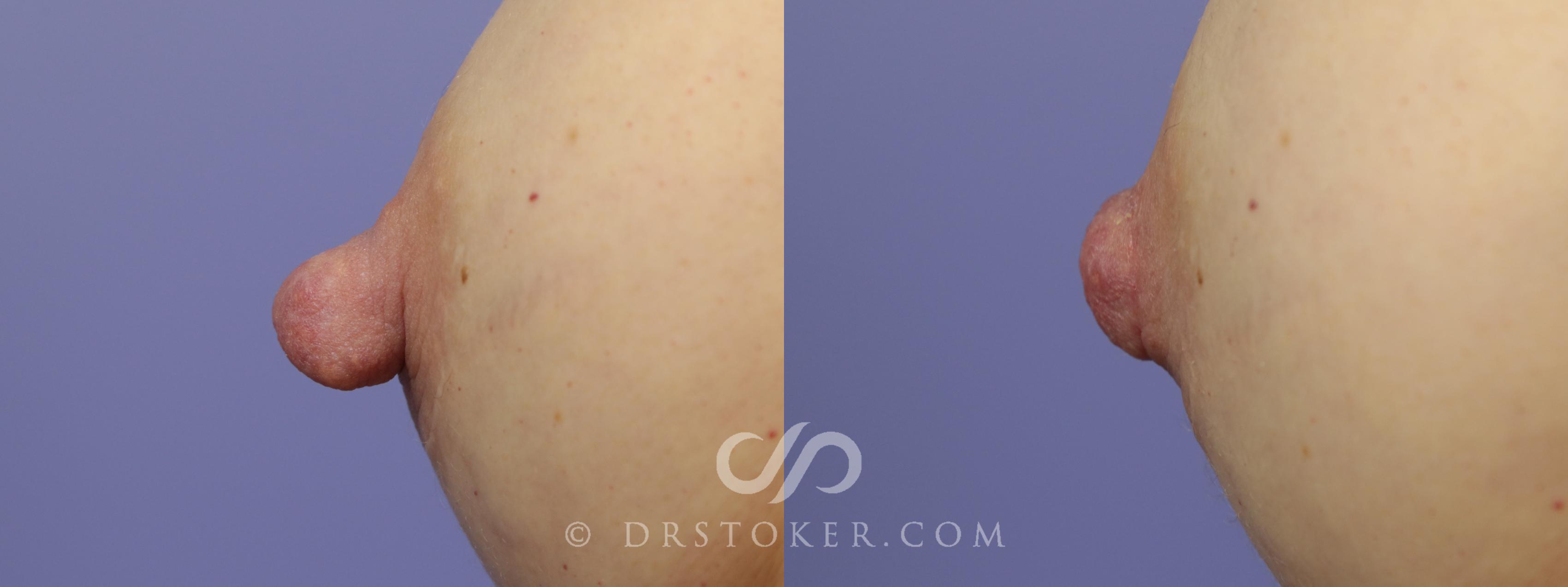 Before & After Nipple - Reduction Case 1203 View #1 View in Los Angeles, CA