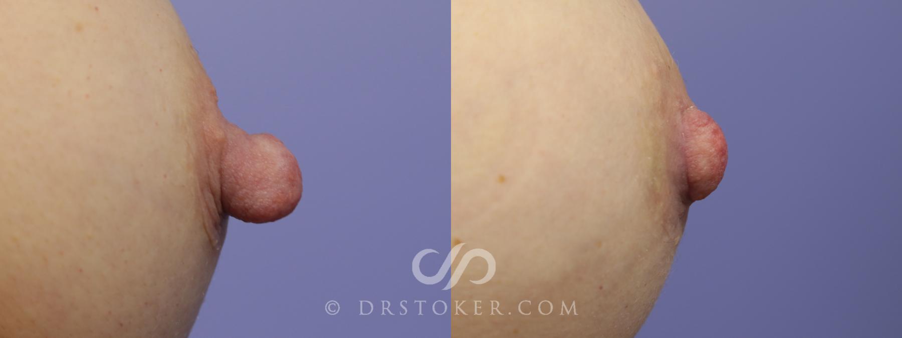Before & After Nipple - Reduction Case 1204 View #1 View in Los Angeles, CA